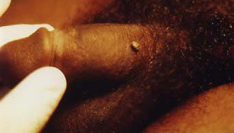 genital warts picture of a wart on the penis