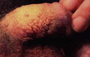 genital warts picture of warts cluster on the side of the penis