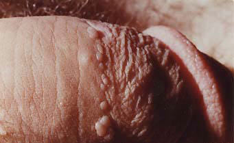 genital warts in a ring around the penis