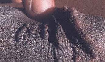 genital warts clustered on the penis